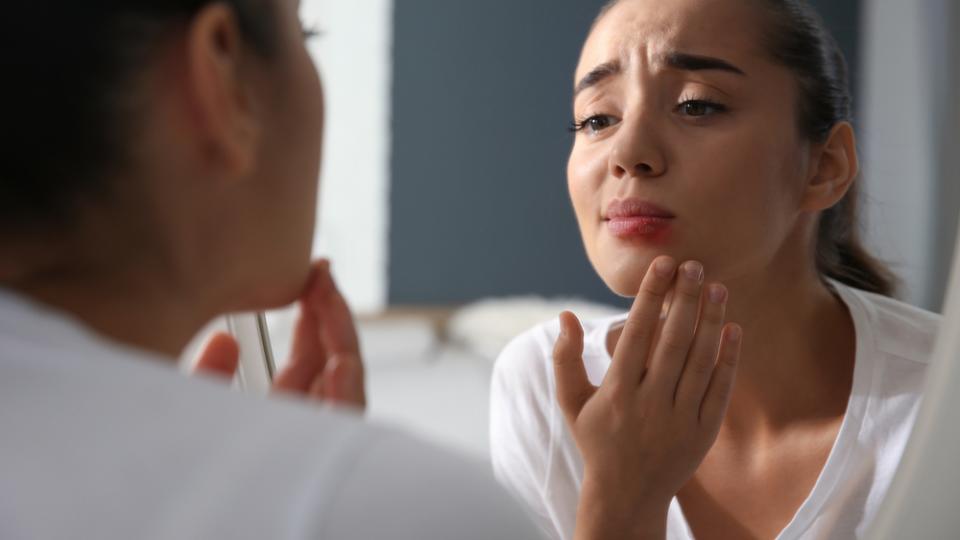 Frau mit Lippenbläschen durch Herpes-Viren