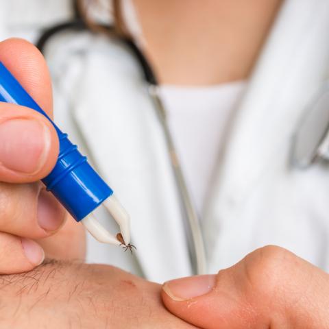 Ärztin entfernt Zecke wegen möglicher Borreliose