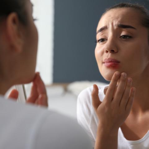 Frau mit Lippenbläschen durch Herpes-Viren